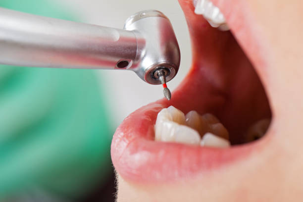 Best Emergency Wisdom Teeth Removal in Ashville, AL